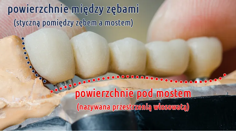 Higiena mostu protetycznego, nić dentystyczna, irygator