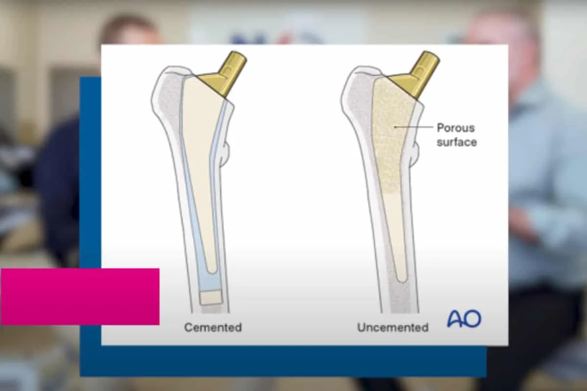 Rodzaje endoprotez biodra cementowa bezcementowa
