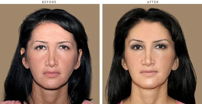 przed i po lifting brwi botoksem