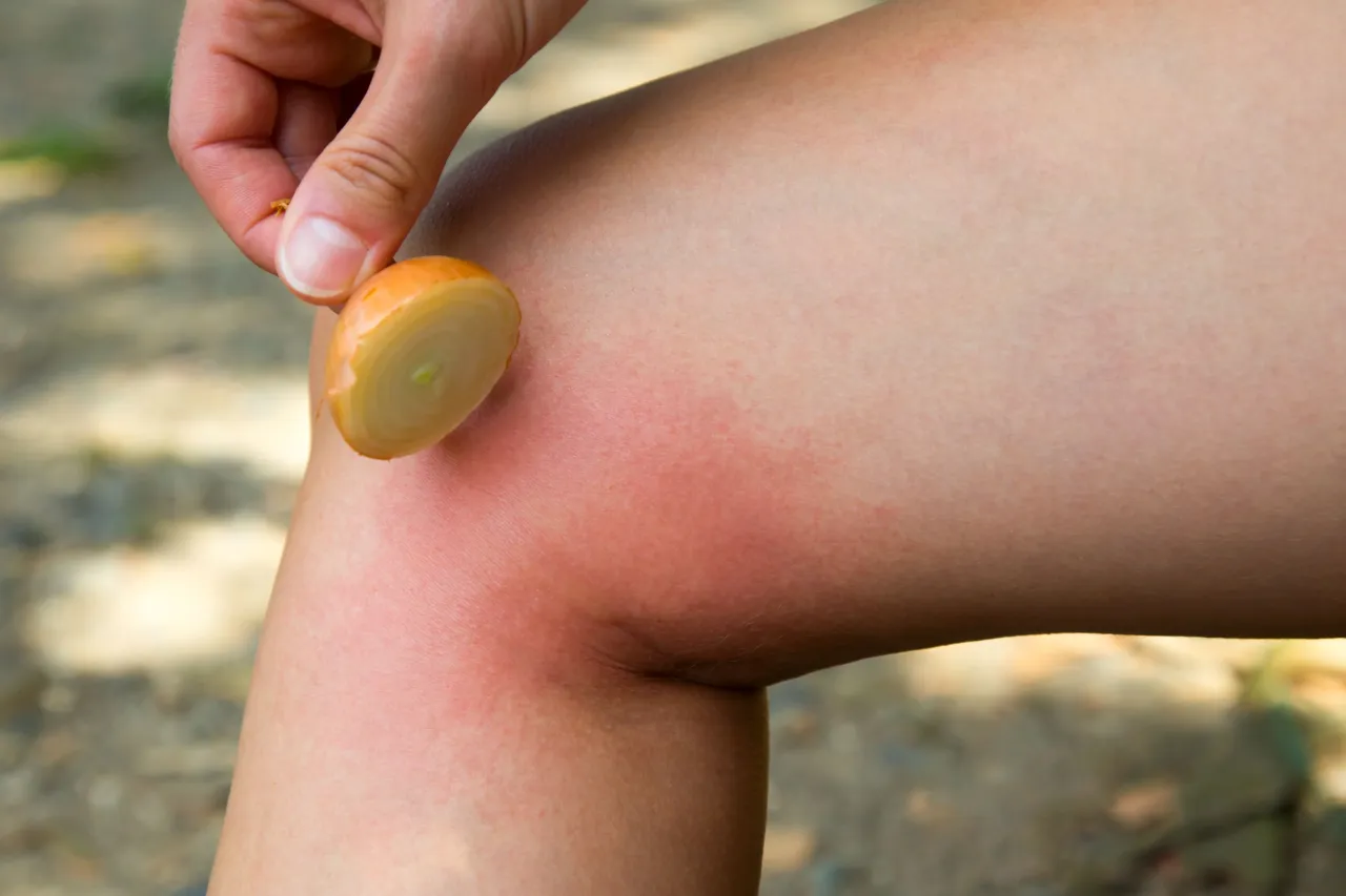 Plaster cebuli na zaczerwienioną skórę po ukąszeniu osy. To może być dobre na ukąszenie osy.