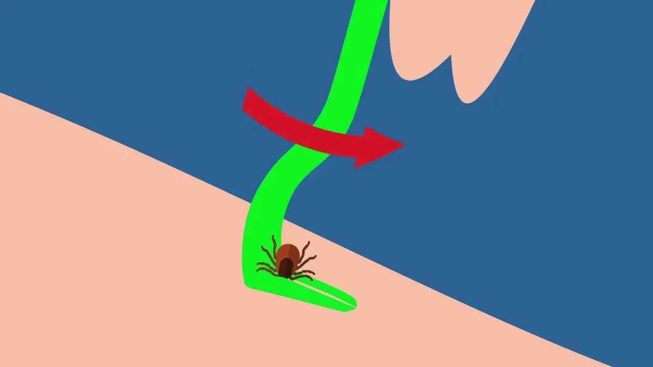 jak prawidłowo usunąć kleszcza haczykiem