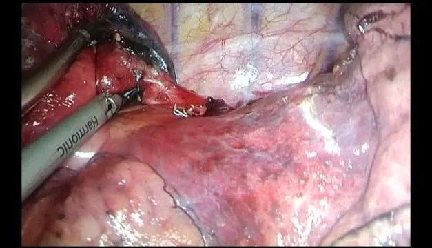 wideotorakoskopia VATS