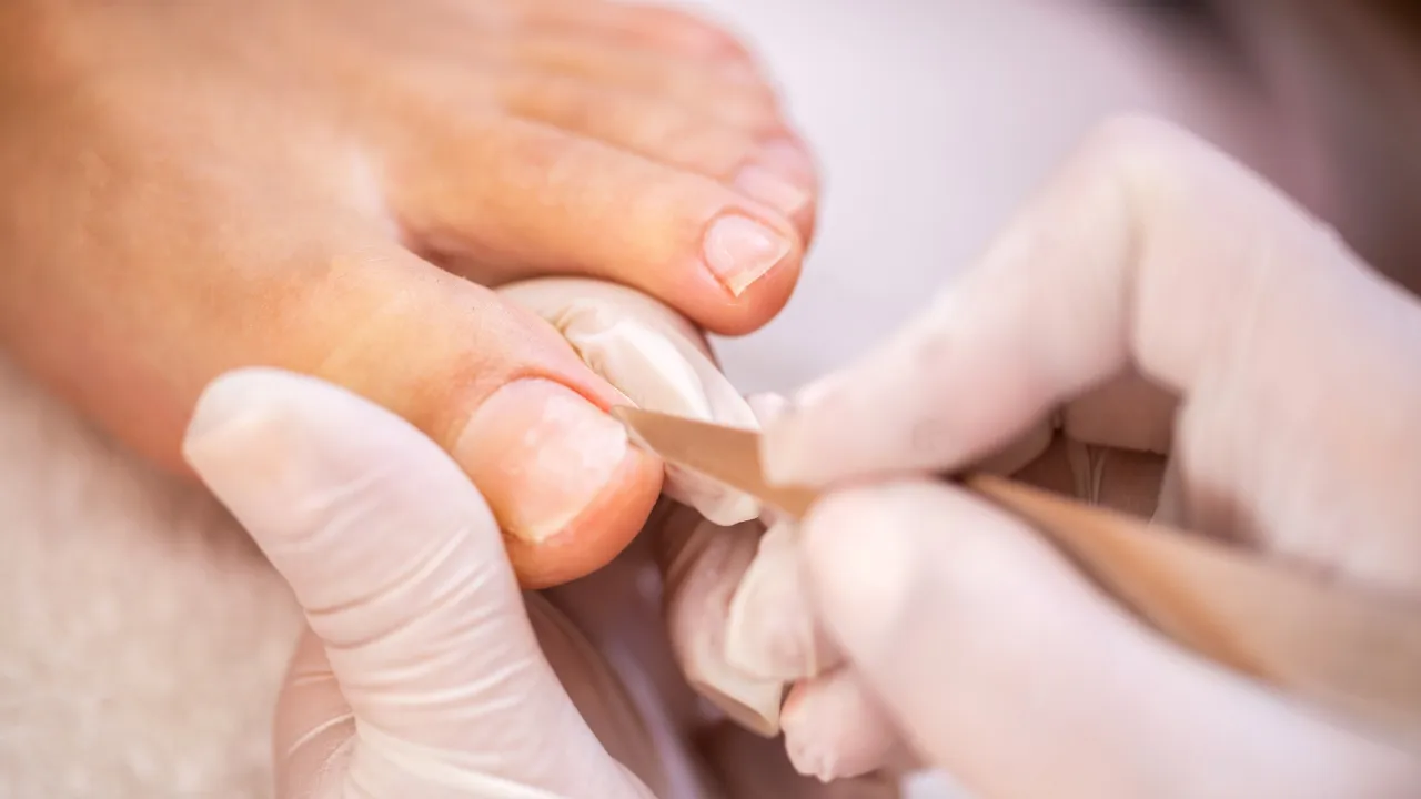 wrastający paznokieć u dziecka