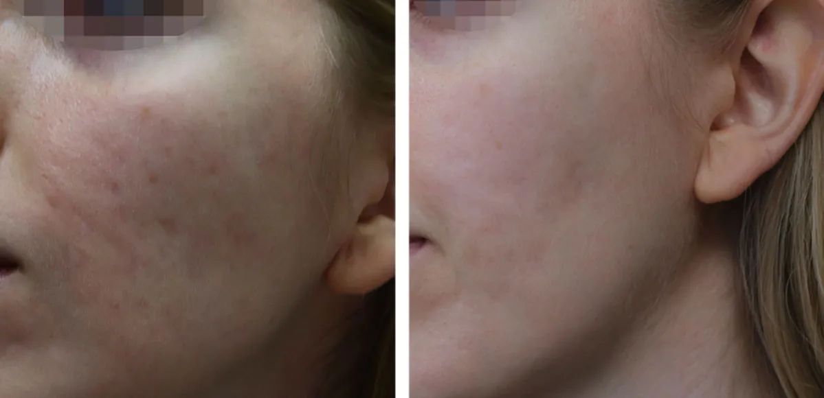 blizny potrądzikowe przed i po