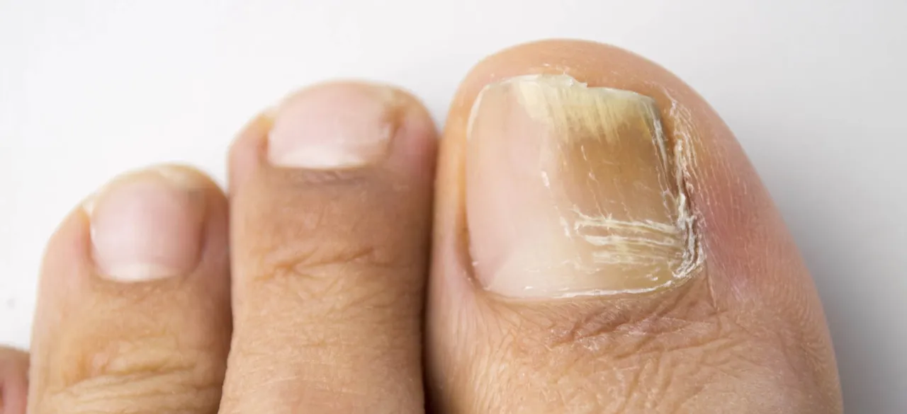 grzybica paznokci u n&oacute;g objawy zdjęcia