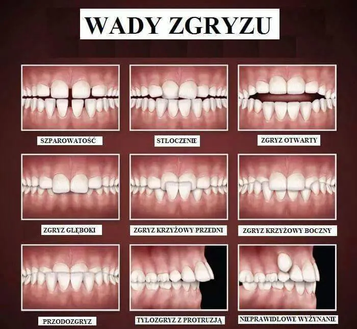 rodzaje wad zgryzu estetyka