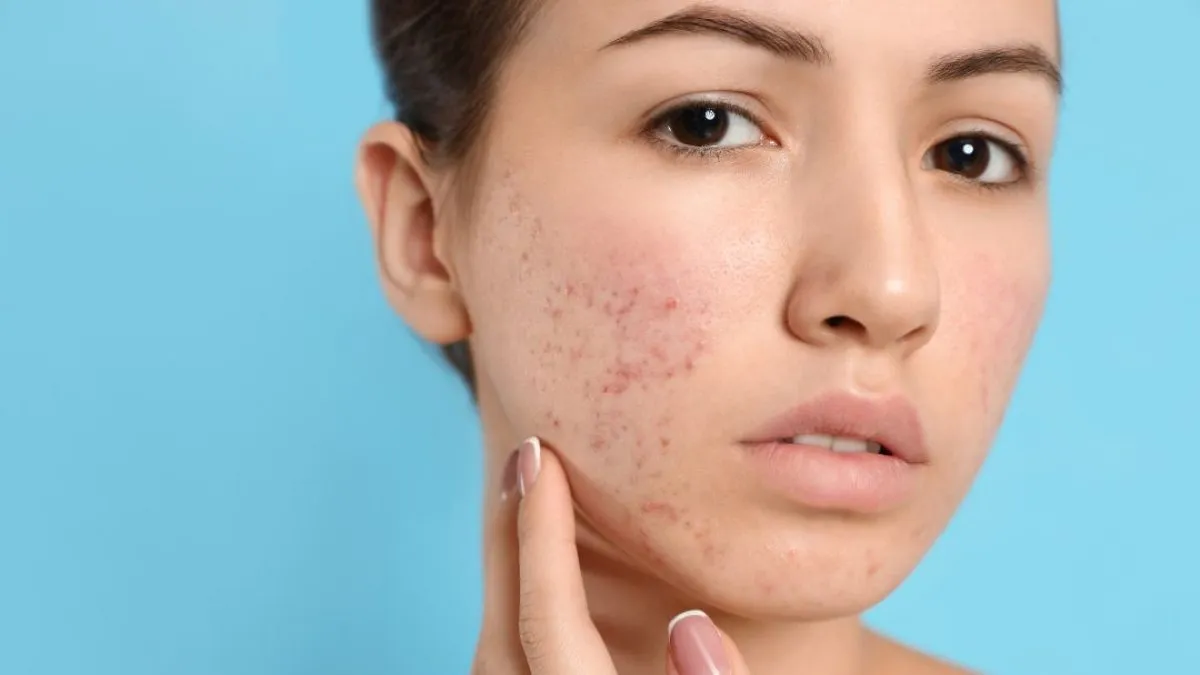 typy cery problematycznej trądzikowej