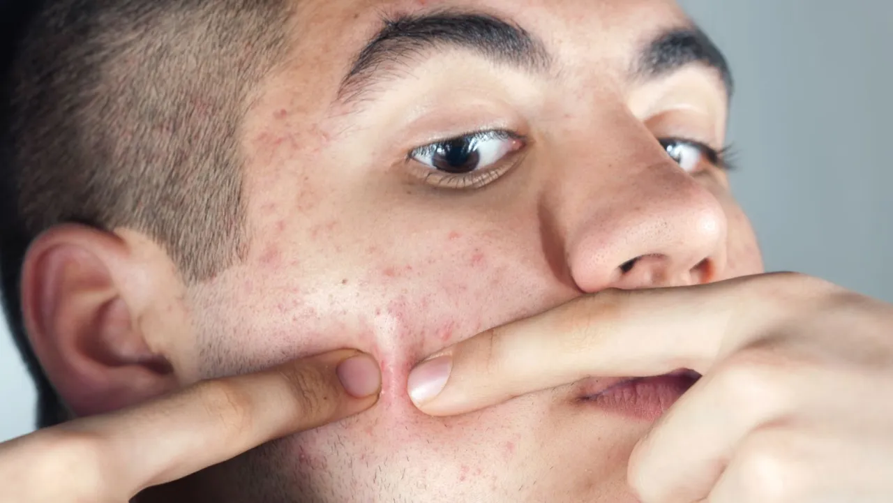 Młody mężczyzna z niedoskonałościami skóry, próbujący palcami nacisnąć podskórnego pryszcza. Szuka sposobu, jak pozbyć się podskórnego pryszcza domowe sposoby.