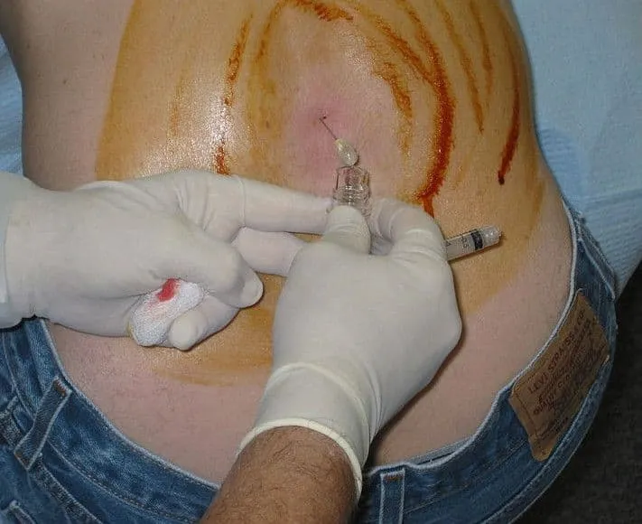 punkcja lędźwiowa procedura