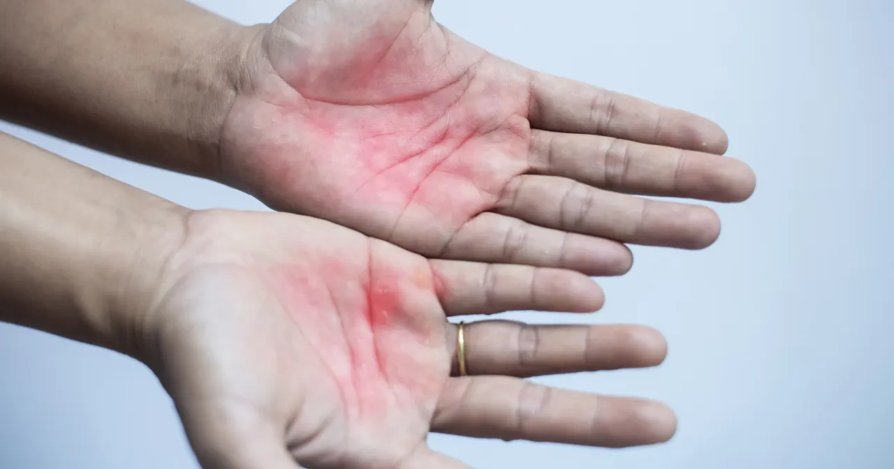 dłonie wątrobowe objawy