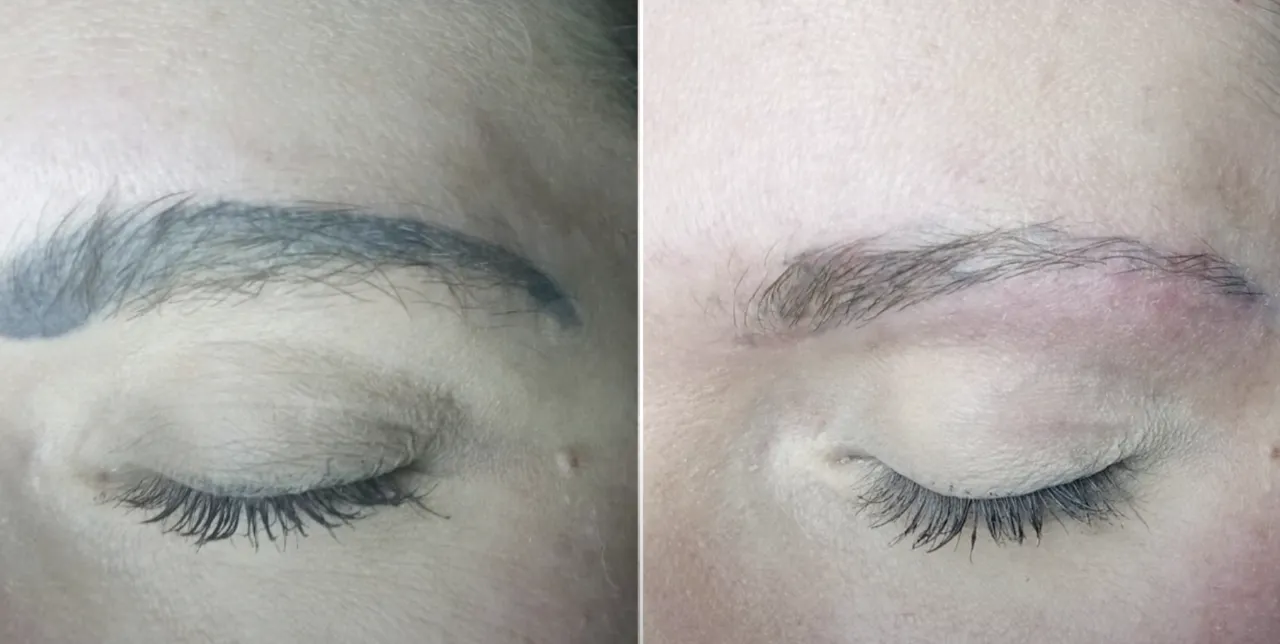 Permanent Make-up Entfernung Augenbrauen Vorher Nachher