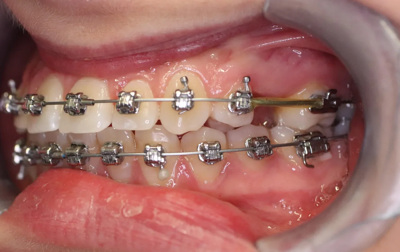 aparat ortodontyczny na oba łuki zębowe przed i po