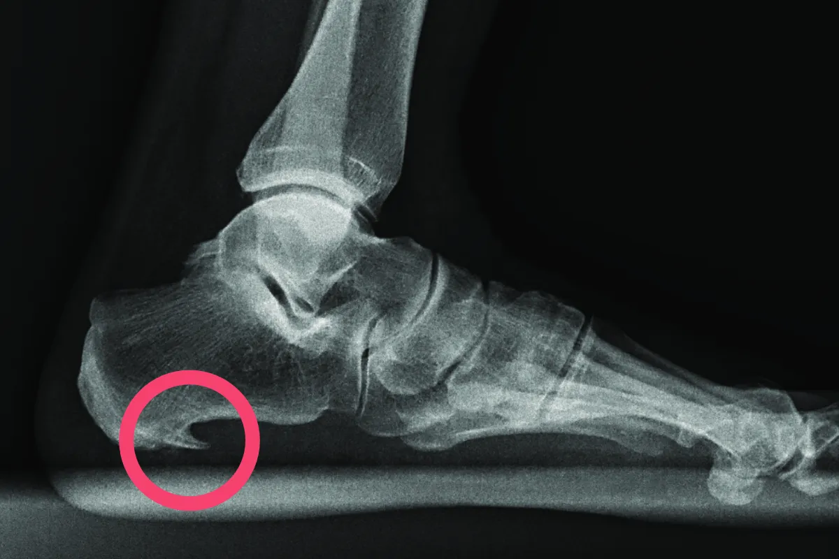 Leki na ostrogę piętową bez recepty