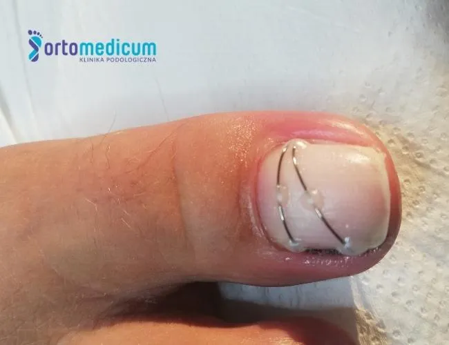 klamra na wrastający paznokieć schemat