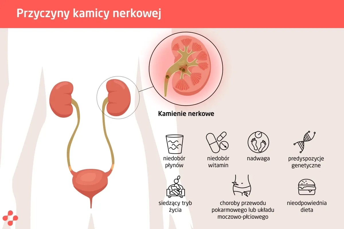 Kamień nerkowy w moczowodzie