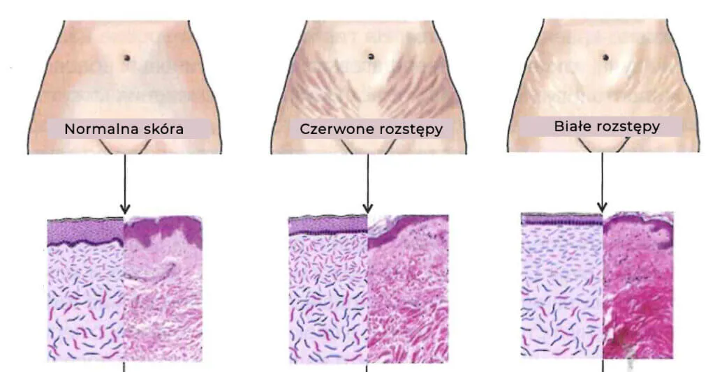 rozstępy fazy powstawania skóra elastyczność