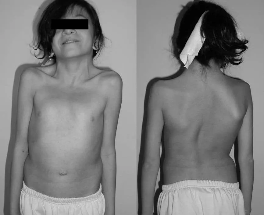 Dziecko z Zespołem Klinefeltera w szkole