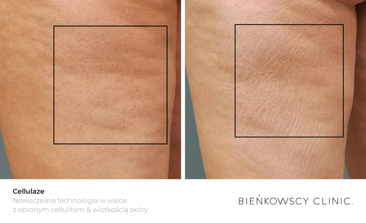 porównanie efektów zabiegów na cellulit przed i po