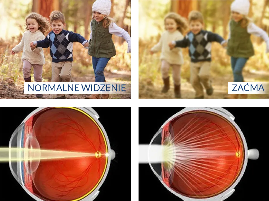 zaćma objawy, jak widzi osoba z zaćmą, efekt halo