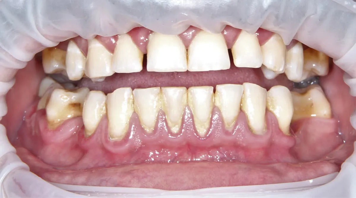 kamień nazębny na zębach