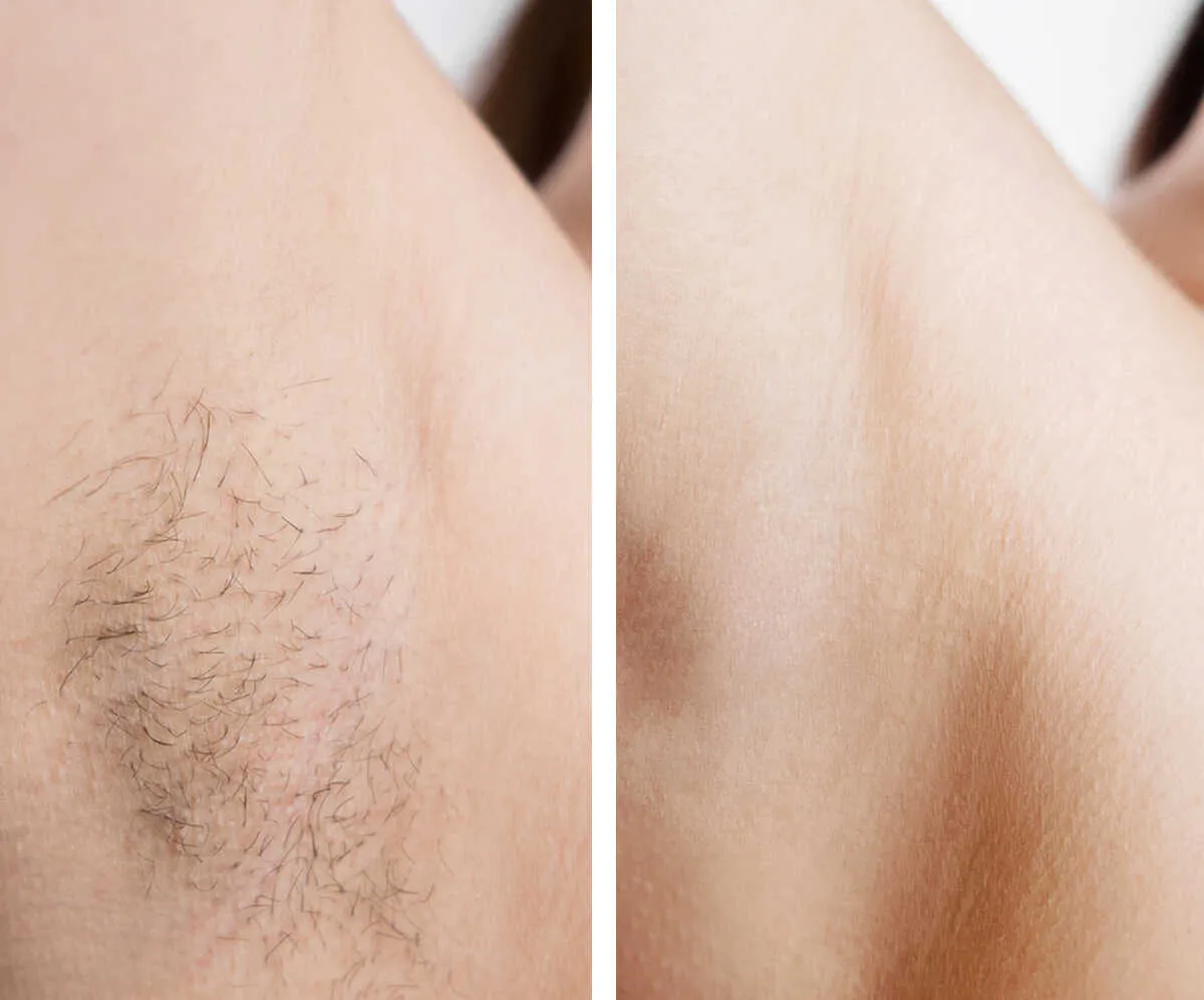 depilacja laserowa efekty przed po
