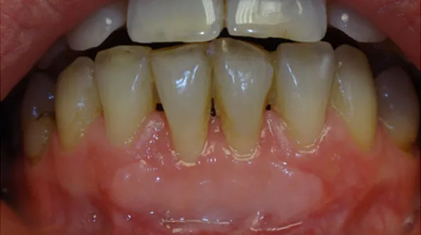 recesja dziąseł objawy wizualne