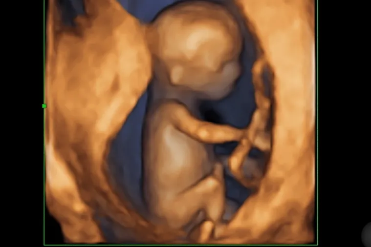 USG genetyczne w 12 tygodniu ciąży