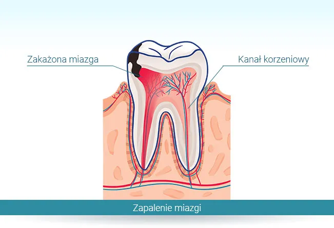 Zdjęcie Dlaczego leki przeciwbólowe nie działają na ból zęba? Przyczyny i rozwiązania