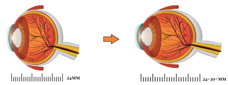 Zdjęcie Kr&oacute;tkowzroczność: Jakie soczewki wybrać? Okulary vs. Kontaktowe