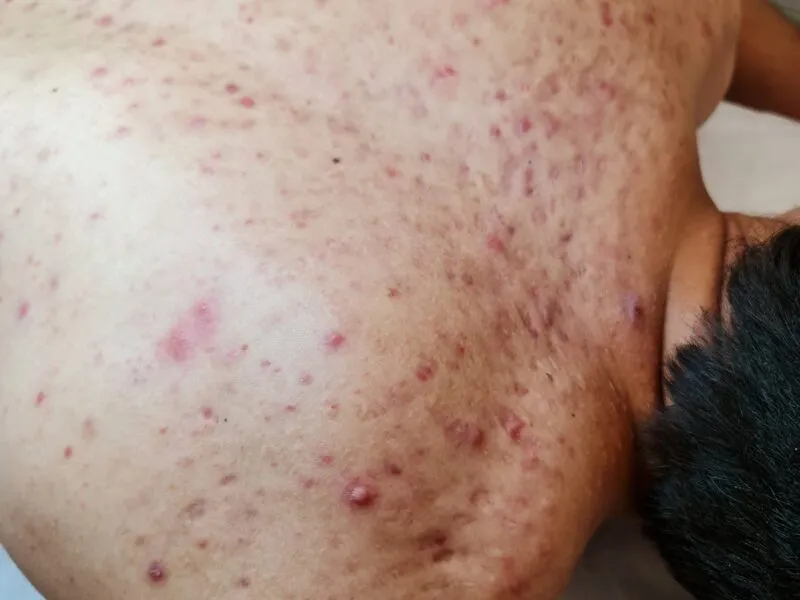 Zdjęcie Jak pozbyć się pryszczy? Kompleksowy przewodnik po leczeniu