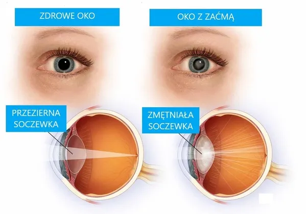 Zdjęcie Operacja zaćmy: kiedy można wykonać zabieg na drugie oko?