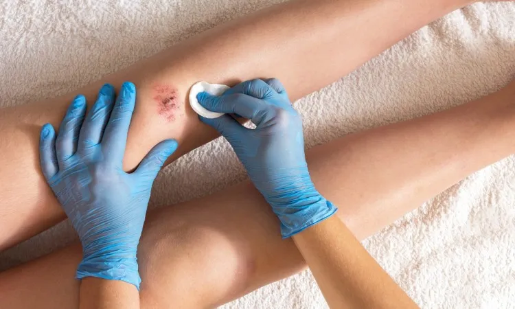 Naturalne sposoby na gojenie strupa