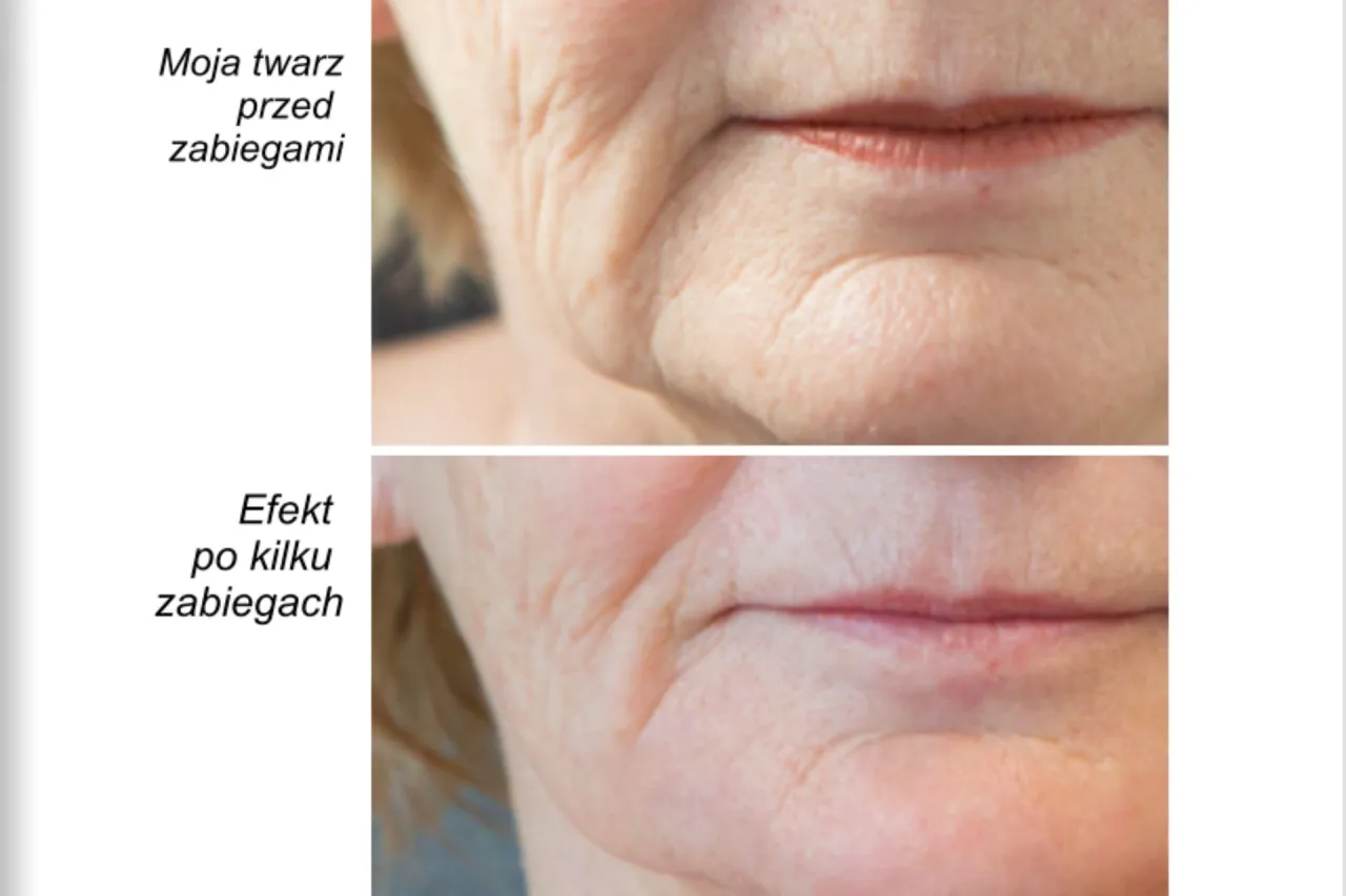 Masaż Kobido przed i po, efekty liftingu twarzy