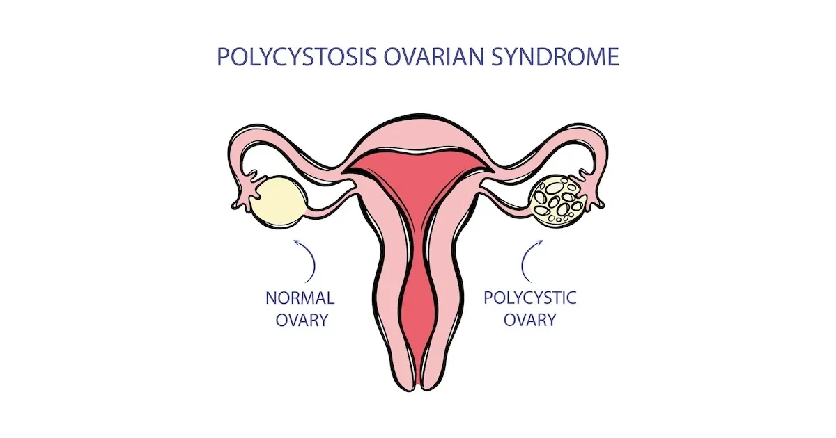 schemat jajników policystycznych, zaburzenia hormonalne tarczycy