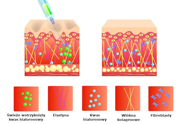 kwas hialuronowy mechanizm działania skóra