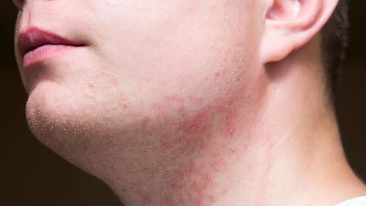 Mężczyzna z podrażnioną sk&oacute;rą po goleniu