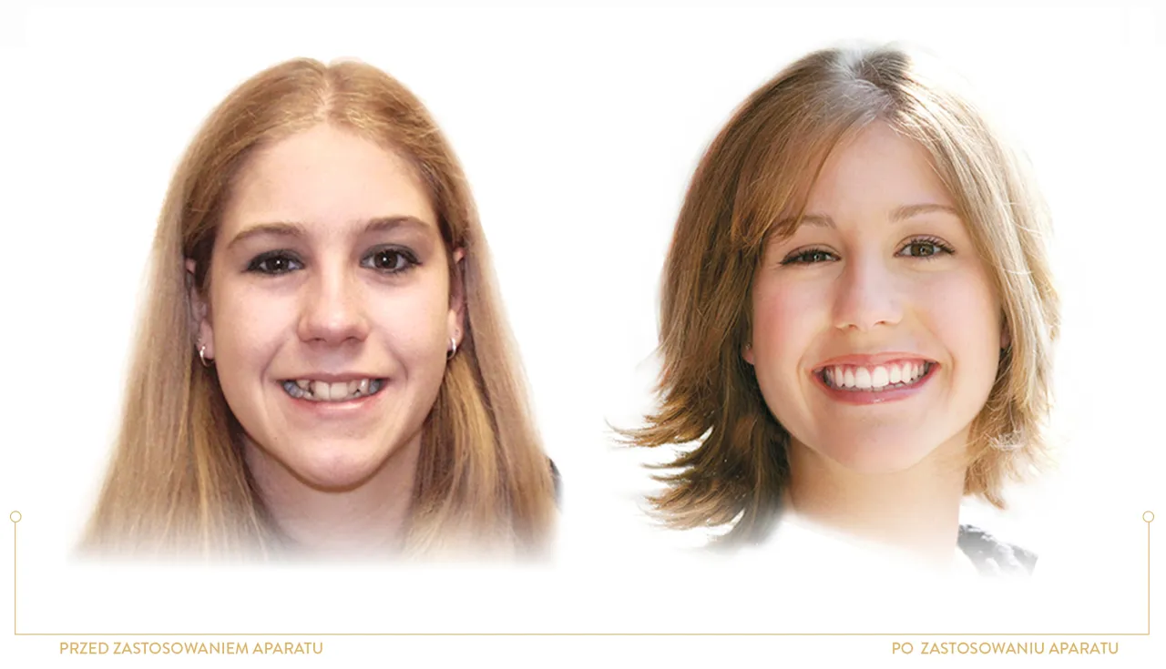R&oacute;żnica w wyglądzie ust przed i po zdjęciu aparatu ortodontycznego