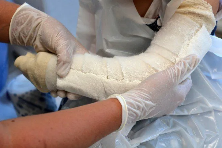 Zdjęcie Złamanie kości promieniowej z przemieszczeniem: skuteczne leczenie