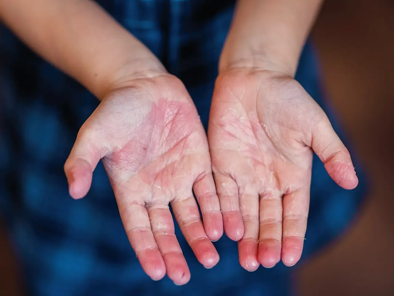 tr&oacute;jkąt fiłatowa szkarlatyna