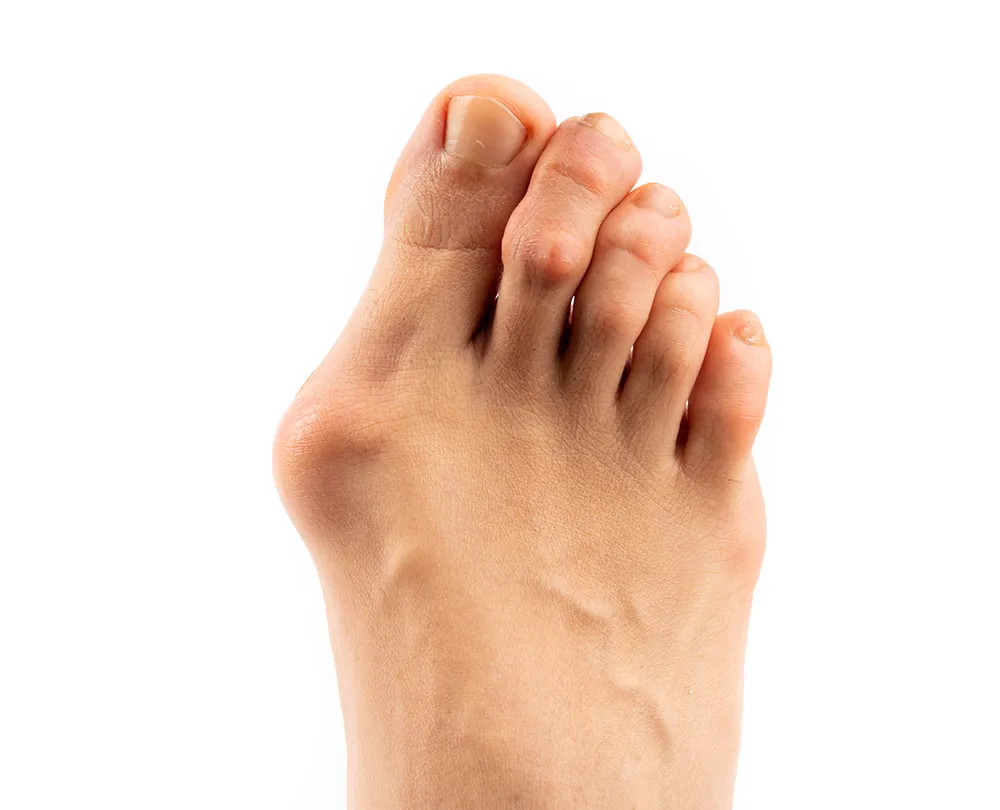 Deformacje stóp: haluksy i palce młotkowate