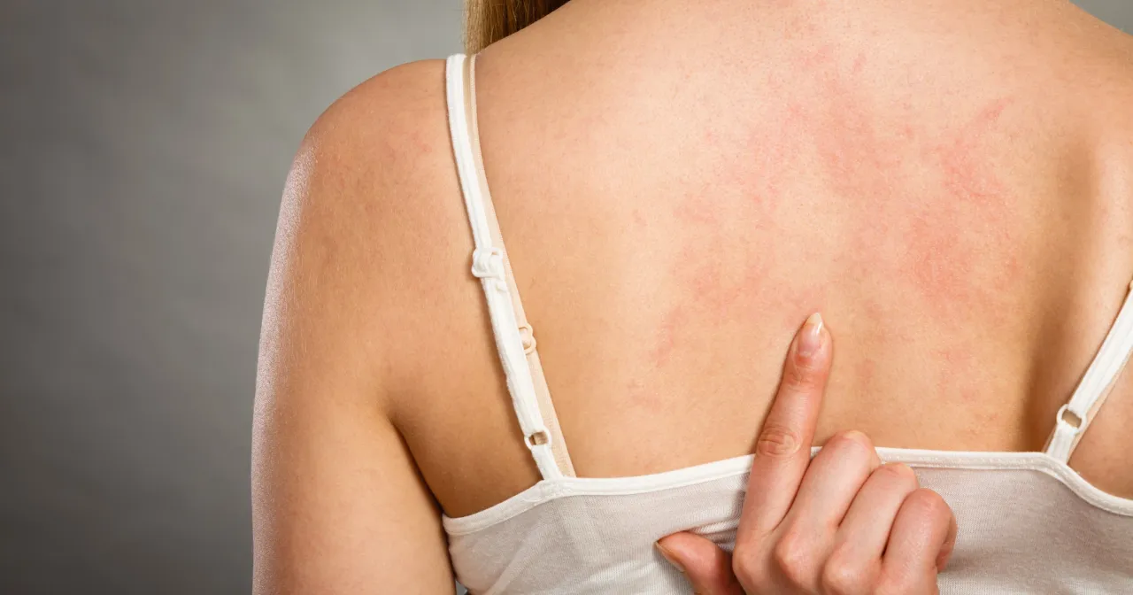 domowe sposoby na pokrzywkę okłady