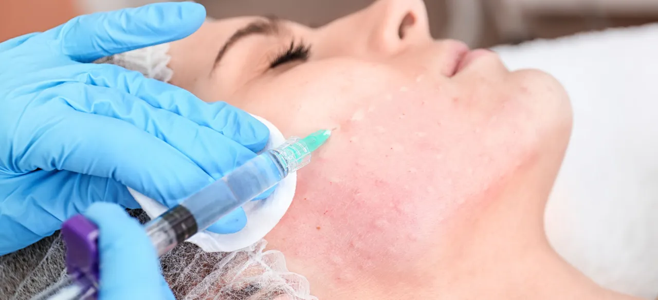 hialuronidaza zabieg rozpuszczania kwasu hialuronowego