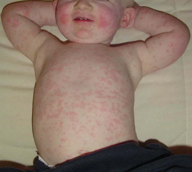 wysypka trzydni&oacute;wka na tułowiu dziecka