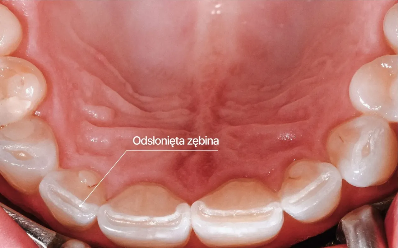 Bruksizm skutki dla zęb&oacute;w