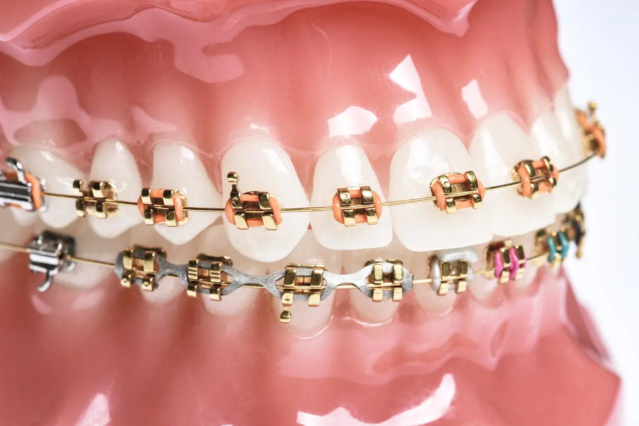 aparat szafirowy na zębach