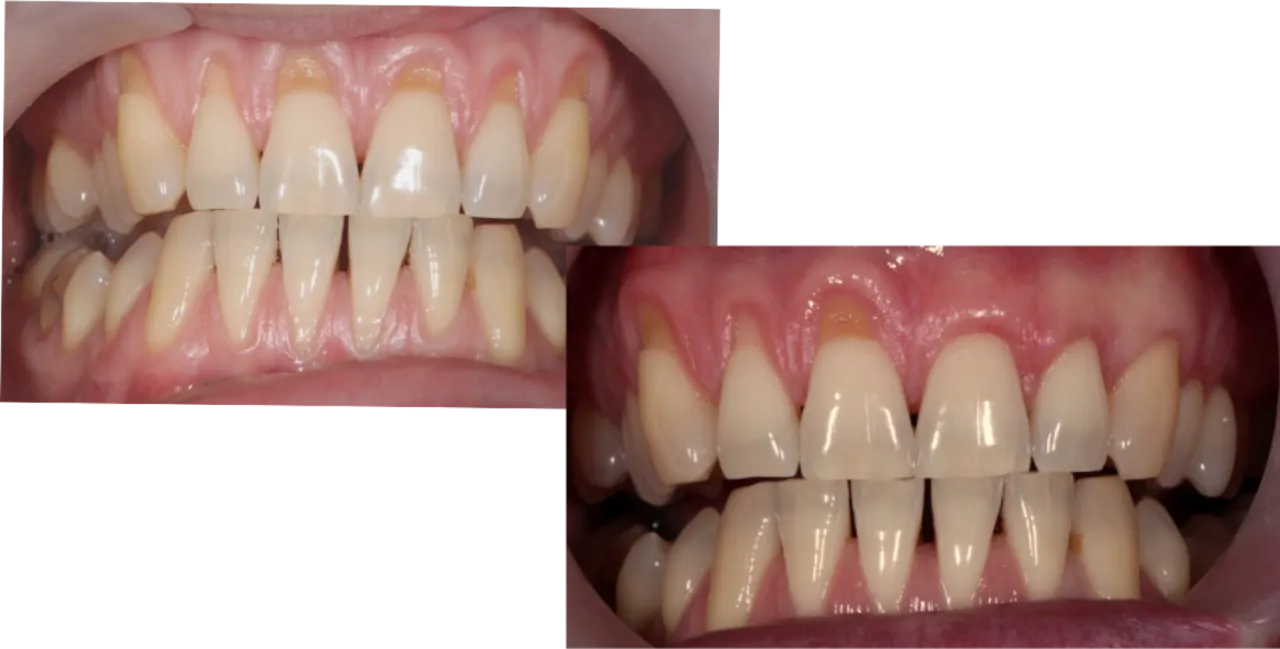 recesja dziąseł przed i po