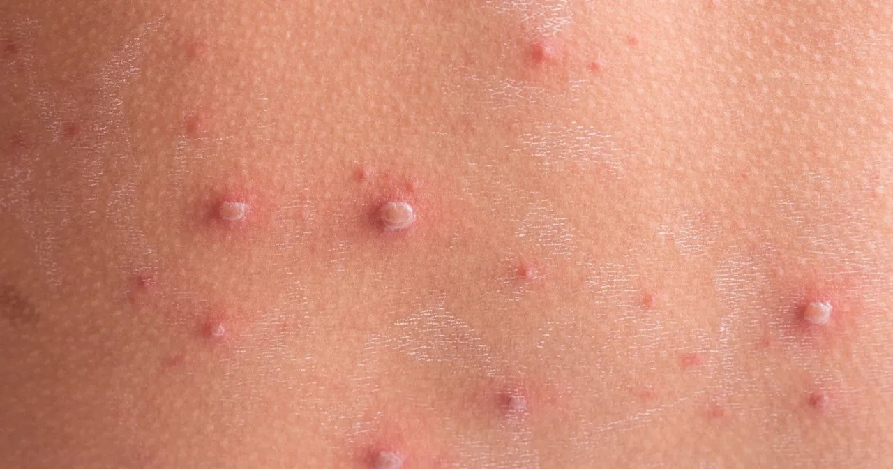 Pielęgnacja sk&oacute;ry dziecka z ospą