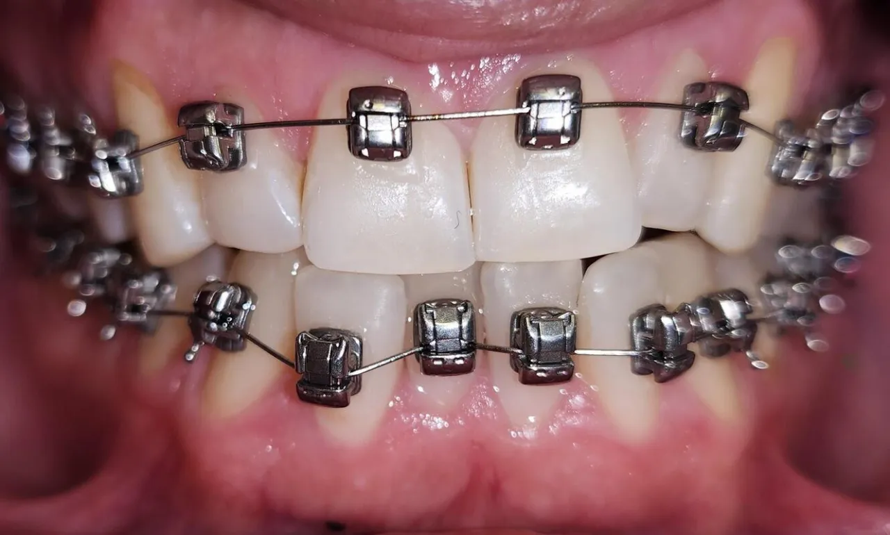 aparat ortodontyczny metalowy na zębach
