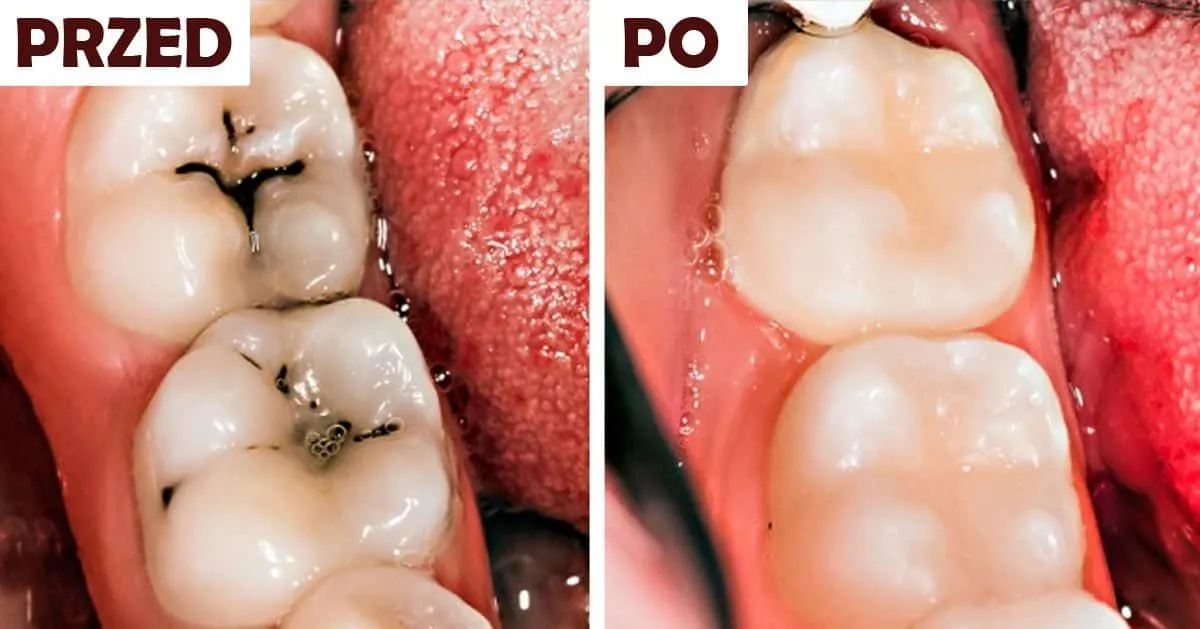 rodzaje plomb dentystycznych porównanie