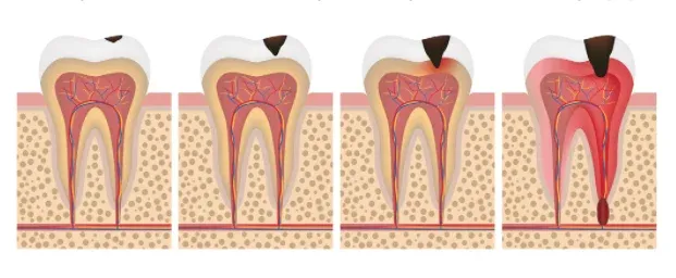 pr&oacute;chnica zęb&oacute;w etapy
